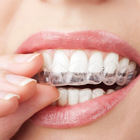 Dentist Las Vegas NV Woman With Clear Aligners